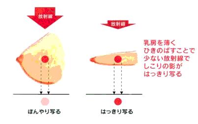 マンモグラフィー 